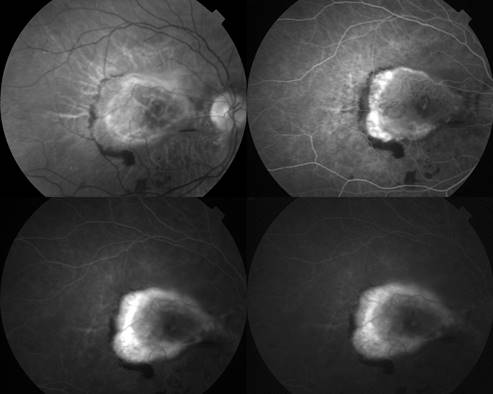dystrophie fibro kystique